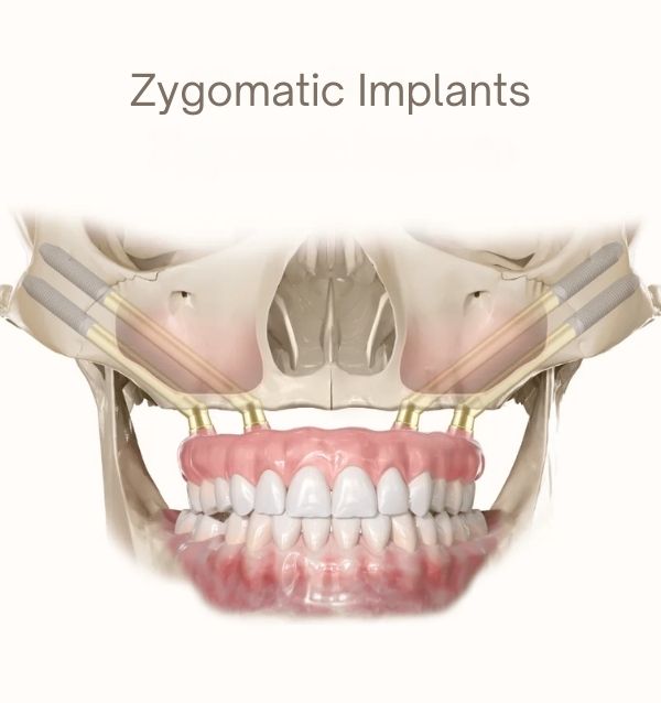 Zygomatic-Implants Surat