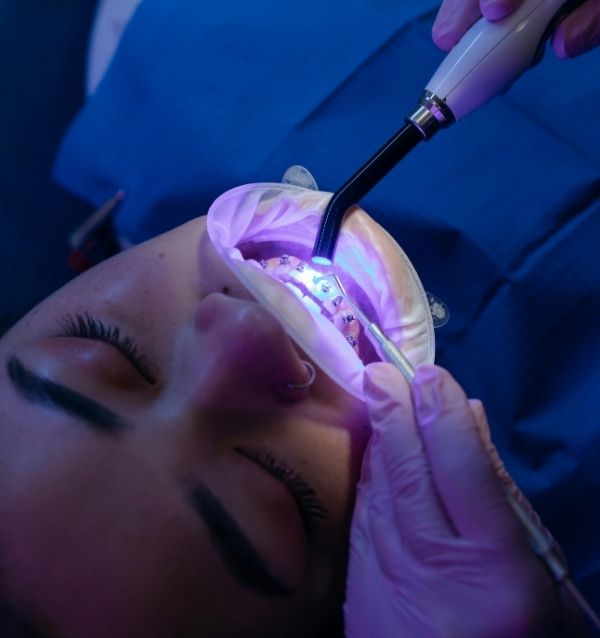 braces treatment in surat