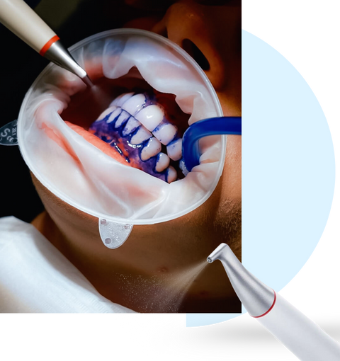 wisdom tooth removal in surat
