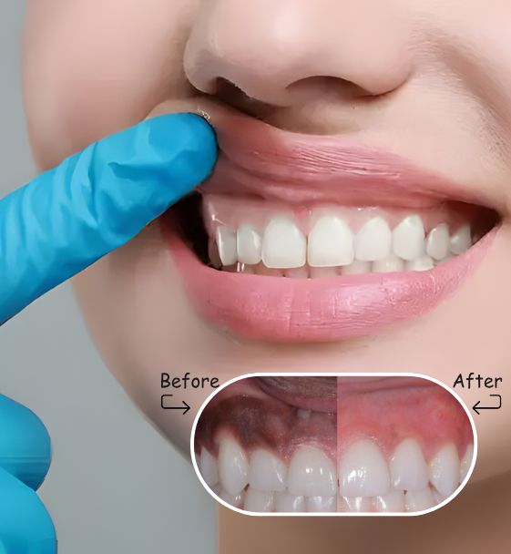 gum depgmentation in surat