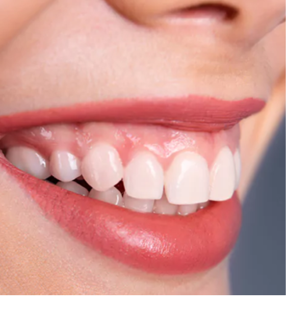 gummy smile treatment in surat