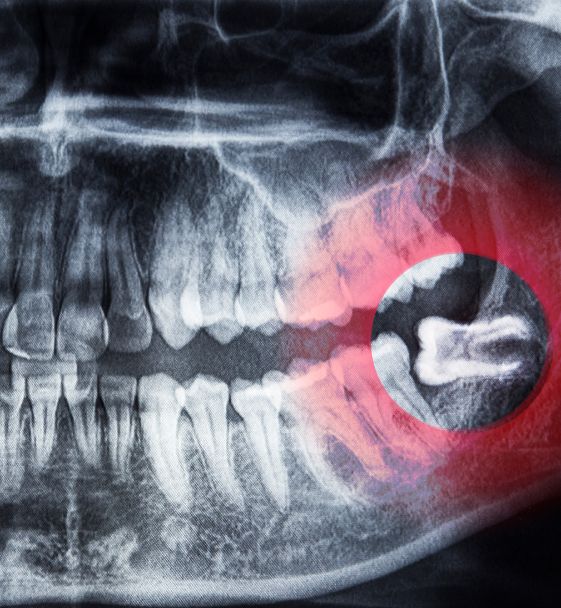 wisdom tooth removal in surat