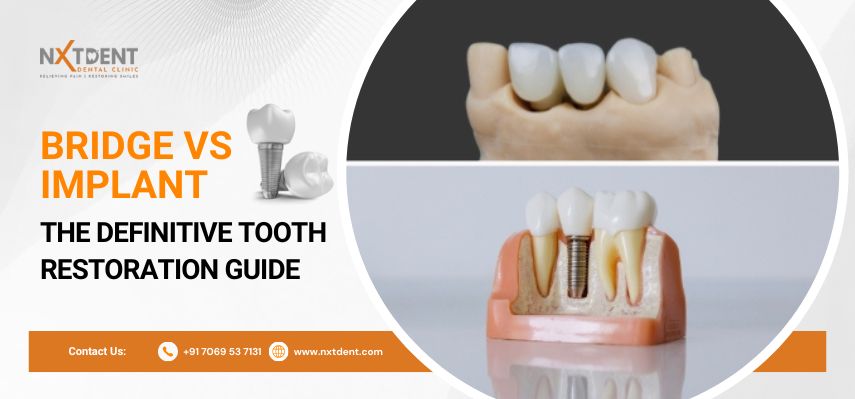 Bridge Vs Implant The Definitive Tooth Restoration Guide