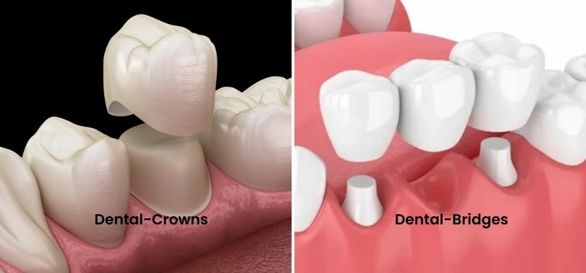 Essential Facts About Dental Crowns and Bridges