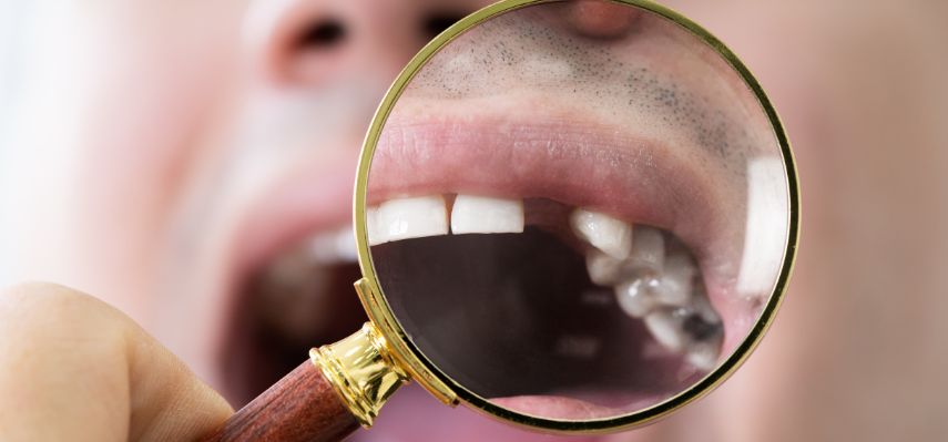 Missing Tooth Replacement What You Need to Know