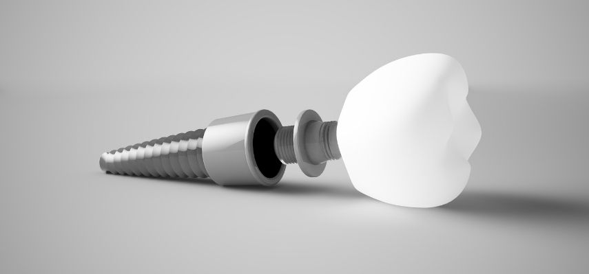 What Are The Benefits Of Dental Implant Supported Dentures