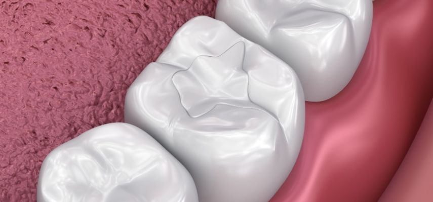 What Are the Benefits of Tooth colored Fillings