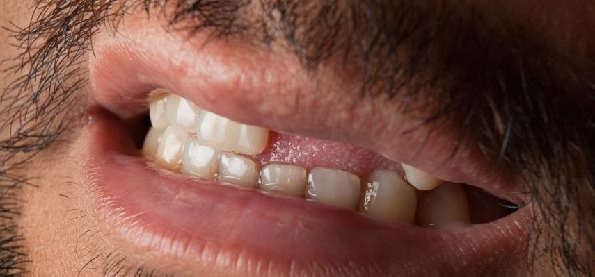 What can you do after losing a tooth