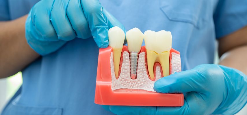 What is Root Canal Dental Treatment