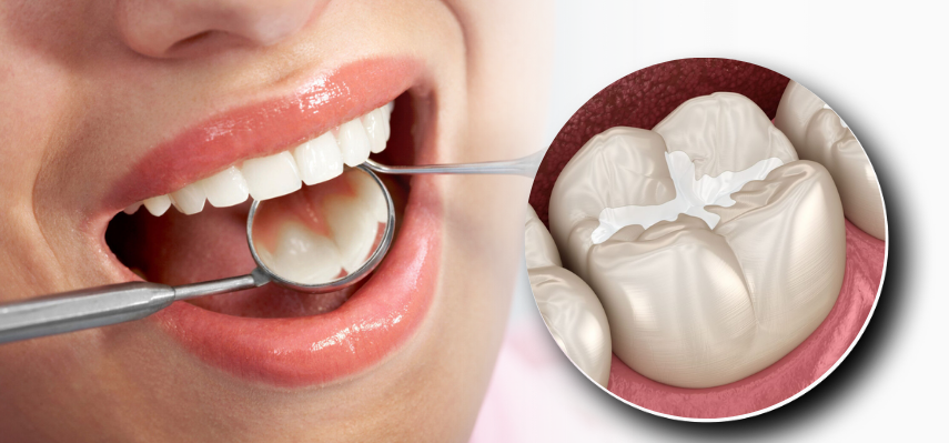 Why Choose Tooth Colored Fillings in Surat? Here’s What You Need to Know